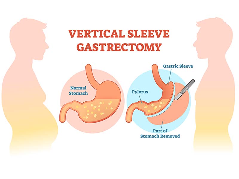 gastric sleeve revision