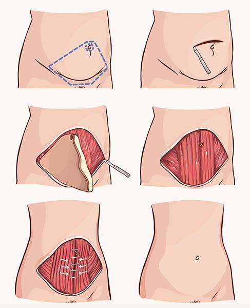 The 5 Stages of Tummy Tuck Recovery